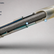 Multi-durometer Pebax catheter shaft cross-section Cutaway of a multi-durometer Pebax catheter shaft showing braid reinforcement, a transition overlap, a softer distal jacket, and an etched PTFE liner.
